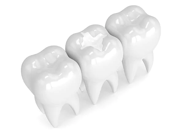 White Fillings for Dental Trauma: Restoring Smiles After Injury